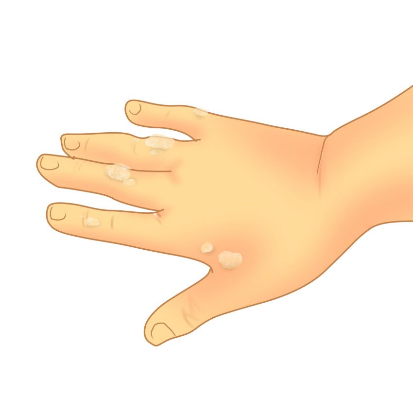 Wartrin Wart Remover - Common Warts on Hands